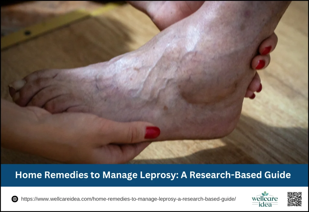 Home Remedies to Manage Leprosy: A Research-Based Guide