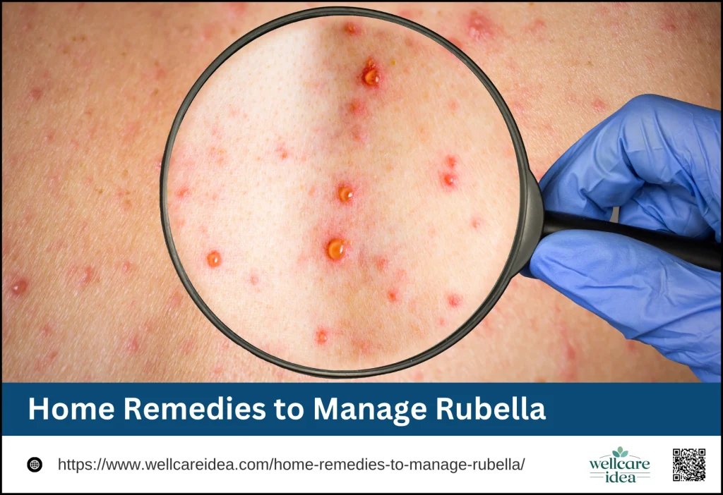 Home Remedies to Manage Rubella
