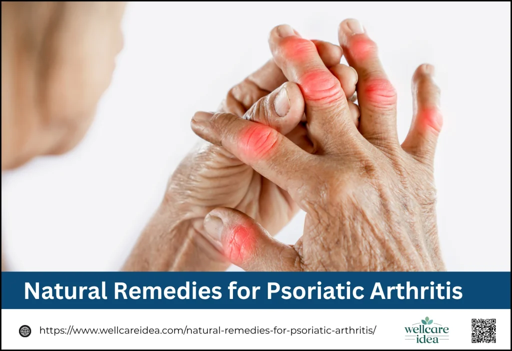 Natural Remedies for Psoriatic Arthritis